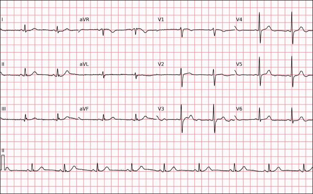 onda N no ecg