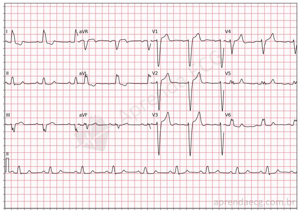 Eletrocardiograma com bloqueio de ramo esquerdo
