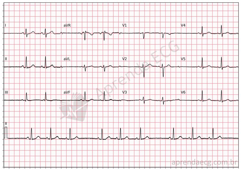 Eletrocardiograma com bloqueio sinoatrial