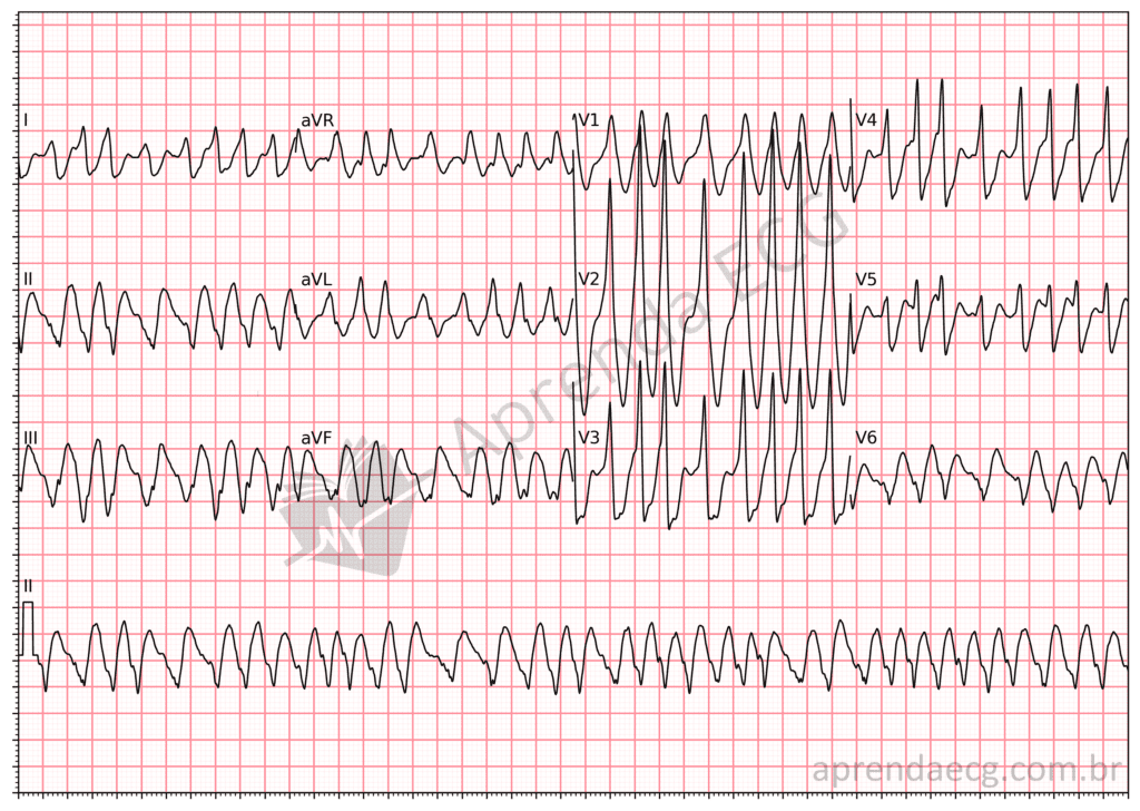 Eletrocardiograma mostrando taquiarritmia irregular de QRS largo compatível com fibrilação atrial pré-excitada