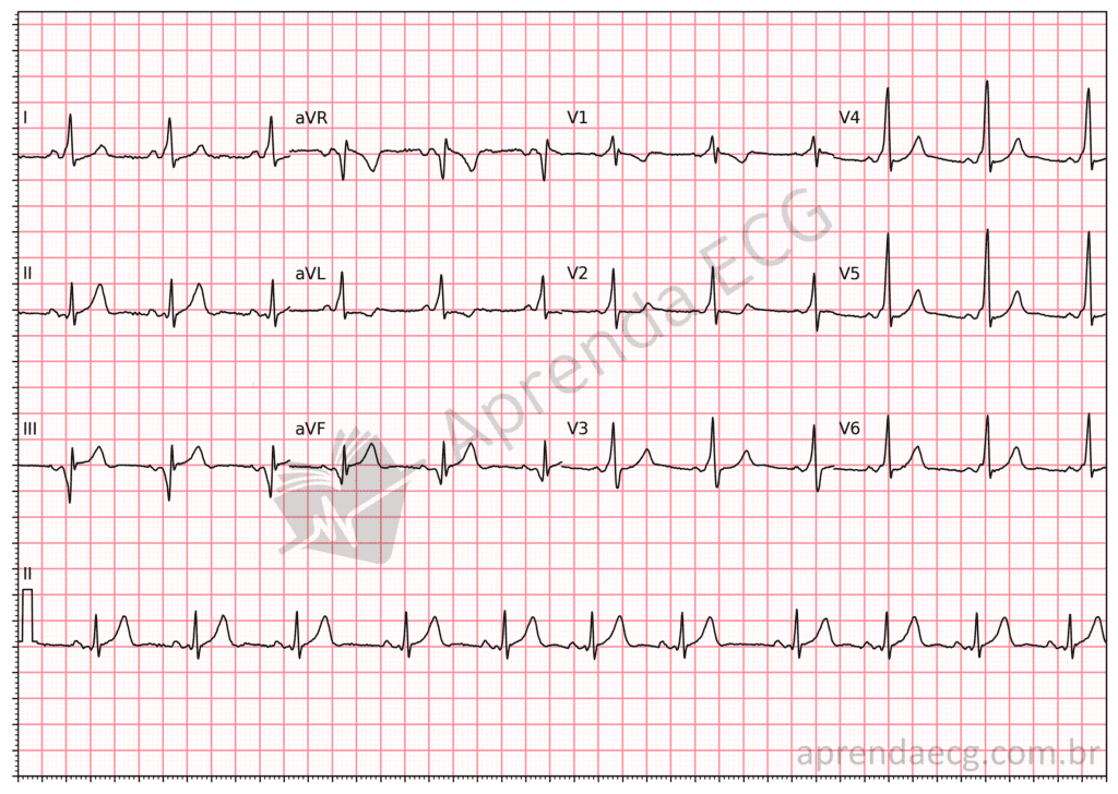 Eletrocardiograma em ritmo sinusal com PR curto e onda delta compatível com pré-excitação ventricular