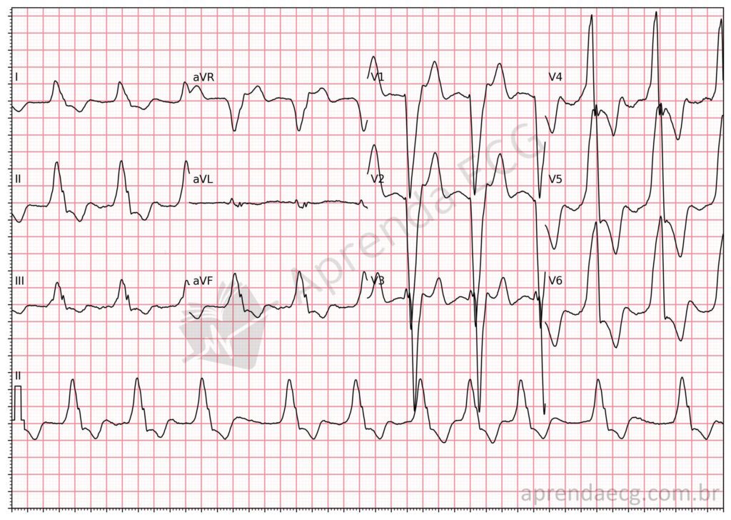 Eletrocardiograma com fibrilação atrial e bloqueio de ramo esquerdo