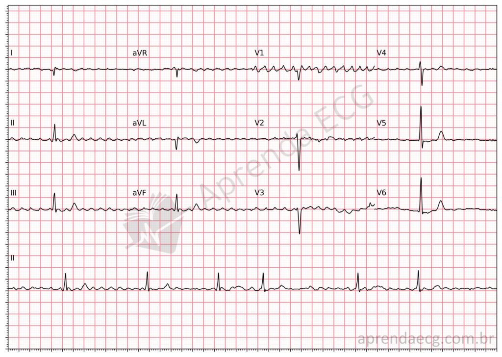 Eletrocardiograma com fibrilação atrial