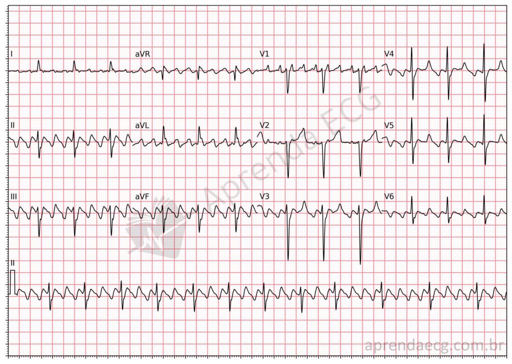 Eletrocardiograma com flutter atrial