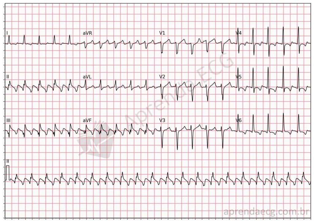 Eletrocardiograma com flutter atrial