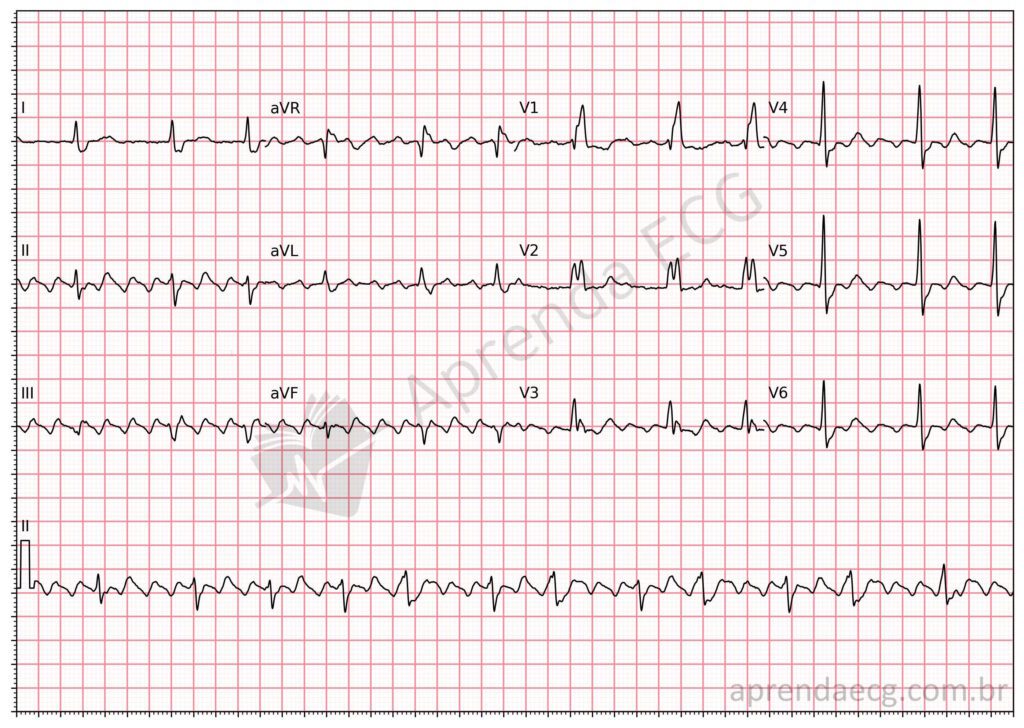 Eletrocardiograma com flutter atrial