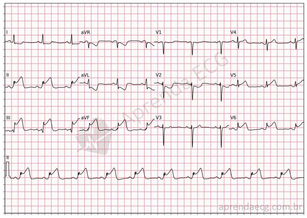Eletrocardiograma com supradesnivelamento do segmento ST e infarto da parede inferolateral