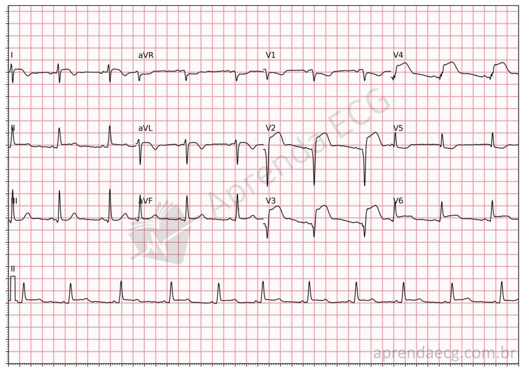 Eletrocardiograma com supradesnivelamento do segmento ST e infarto da parede anterior extensa