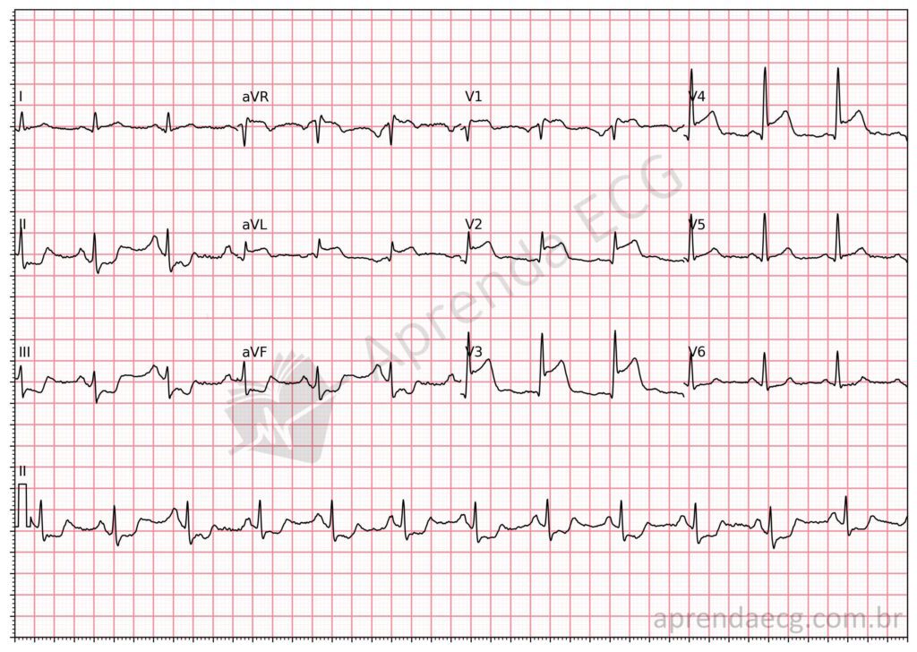Eletrocardiograma com supradesnivelamento do segmento ST e infarto da parede anterior extensa