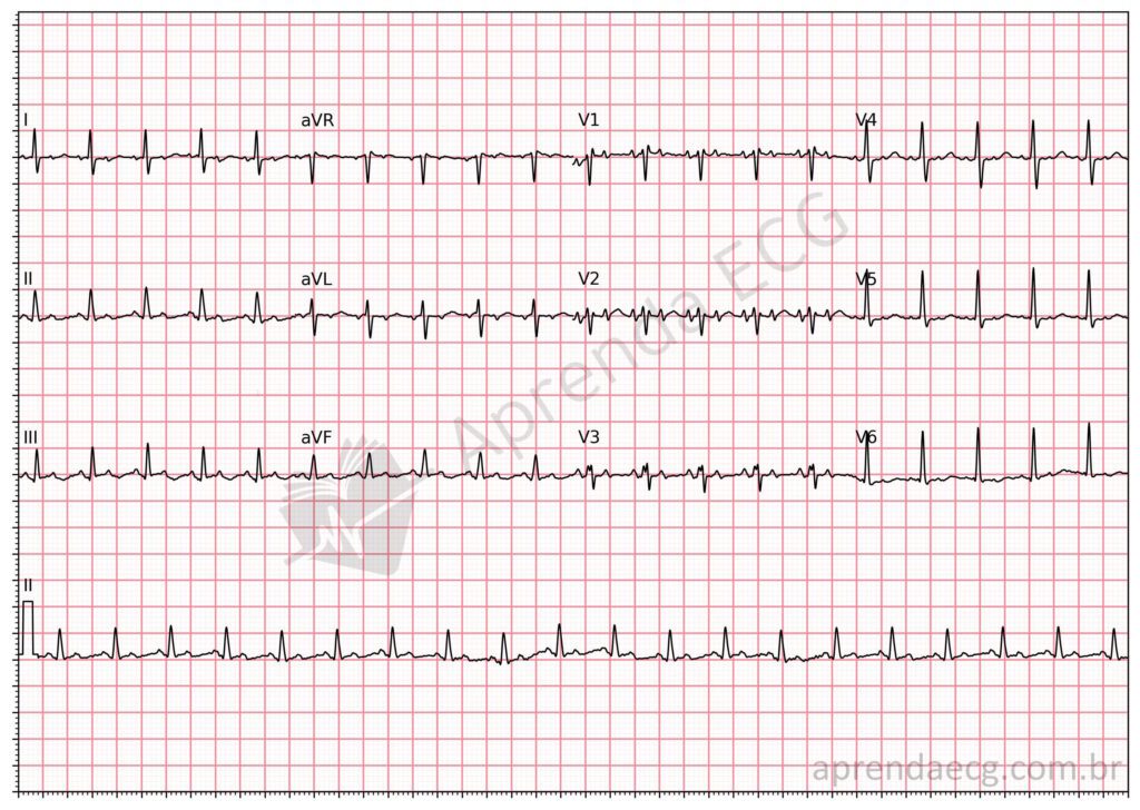 Eletrocardiograma com taquicardia atrial focal