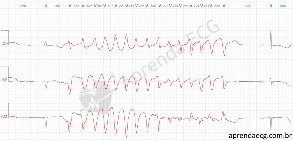 Eletrocardiograma com torsades de pointes