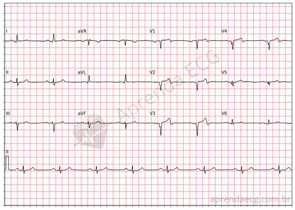 Eletrocardiograma com área eletricamente inativa (onda Q) anteroapical