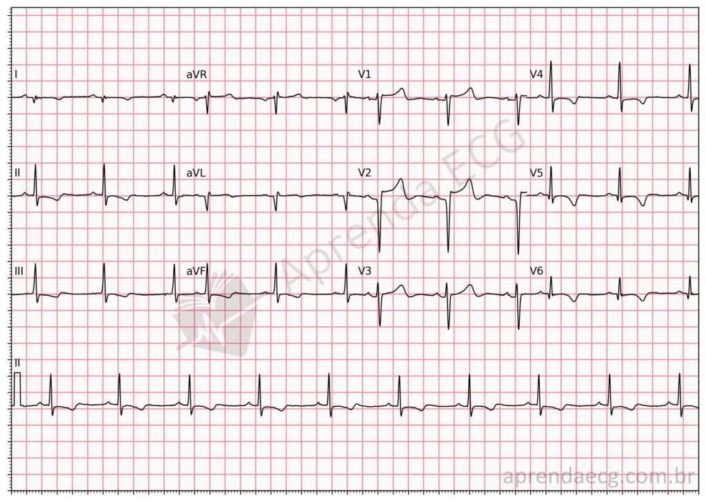 Eletrocardiograma com área eletricamente inativa (onda Q) anterior média