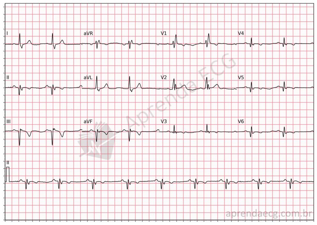 Eletrocardiograma com área eletricamente inativa (onda Q) inferior