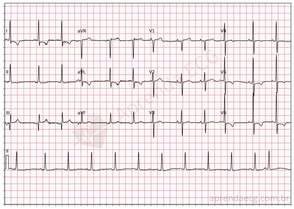 Eletrocardiograma com padrão de Aslanger