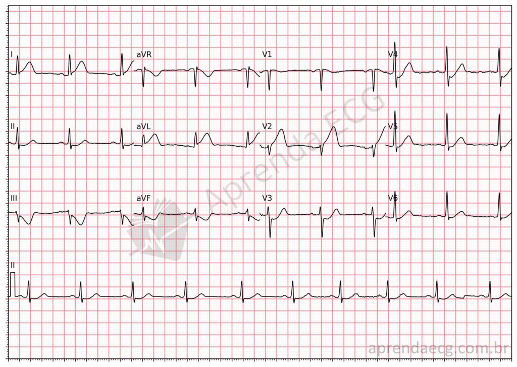 Eletrocardiograma com sinal da bandeira da áfrica do sul e infarto da parede anterior média
