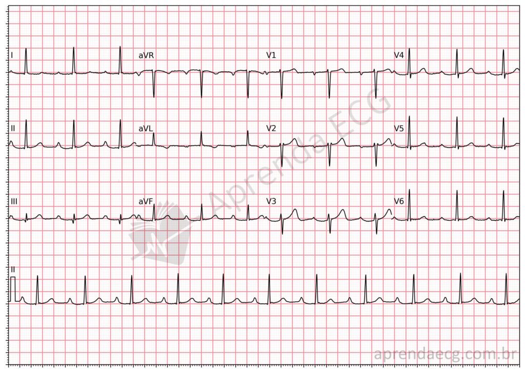 Eletrocardiograma com bloqueio atrioventricular de primeiro grau