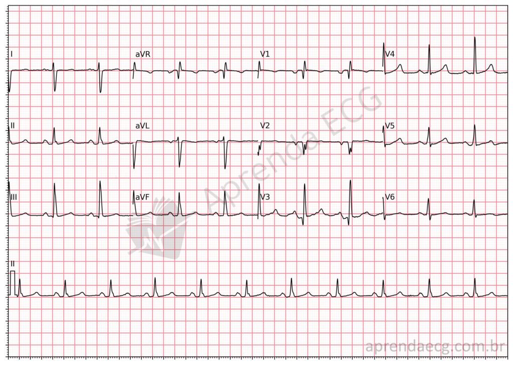 Eletrocardiograma com bloqueio divisional posteroinferior (BDPI)