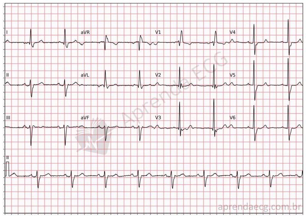 Eletrocardiograma com bloqueio de ramo direito (BRD) associado ao bloqueio divisional anterossuperior (BDAS)