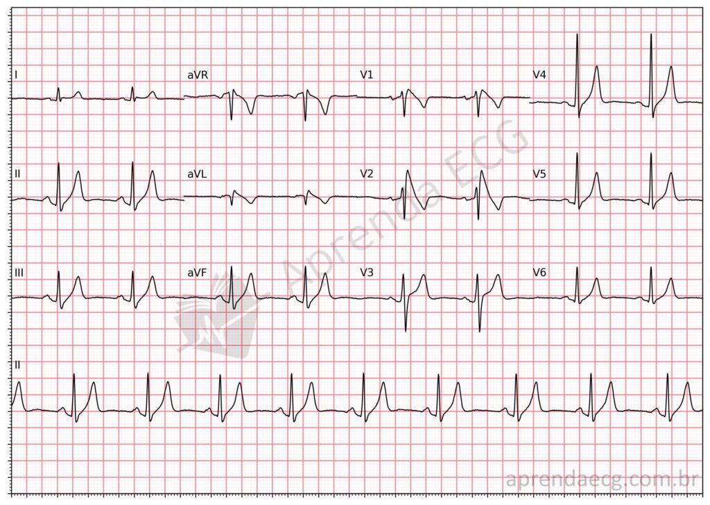 Eletrocardiograma com padrão de Brugada tipo 1