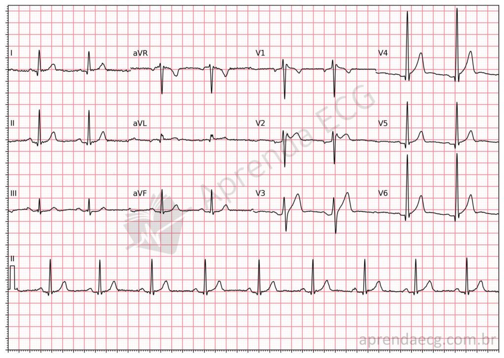 Eletrocardiograma com padrão de Brugada tipo 2