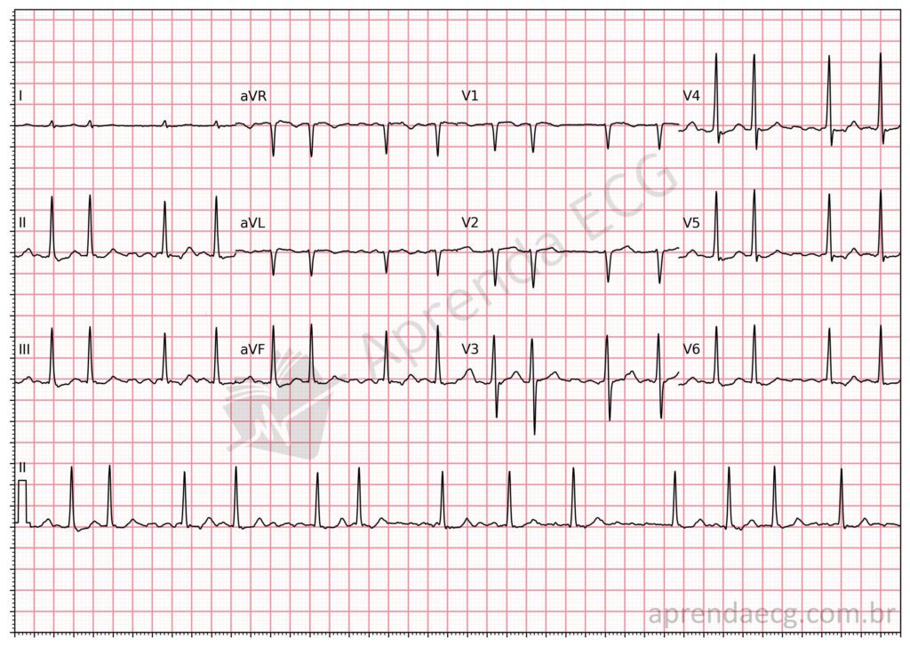 Eletrocardiograma com fibrilação atrial