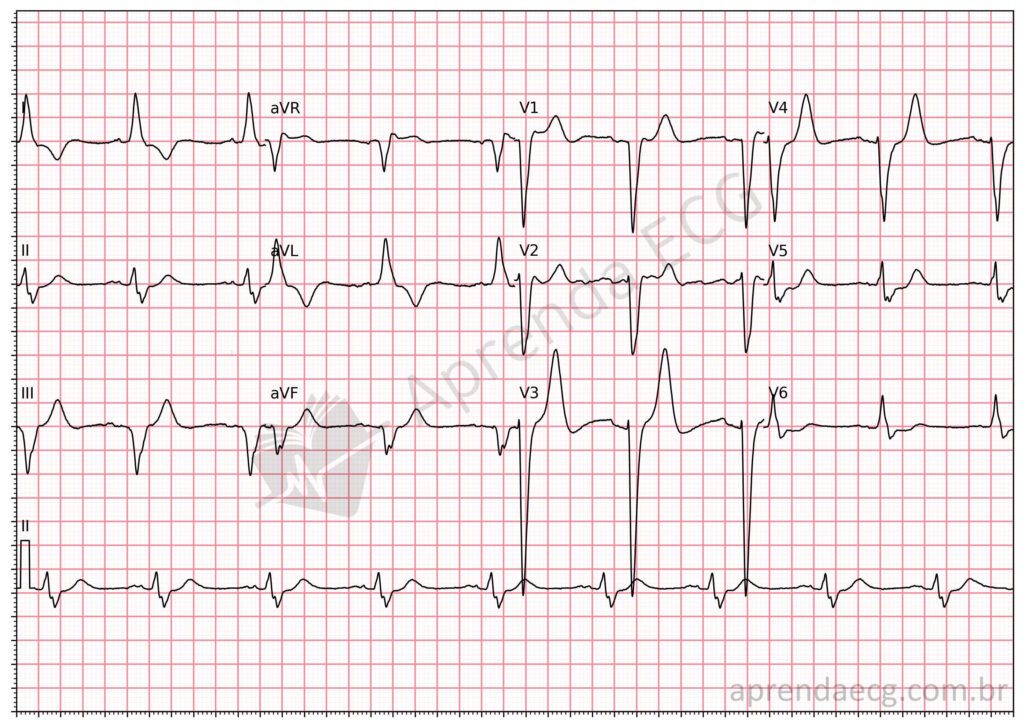 Eletrocardiograma com bloqueio periférico intraventricular