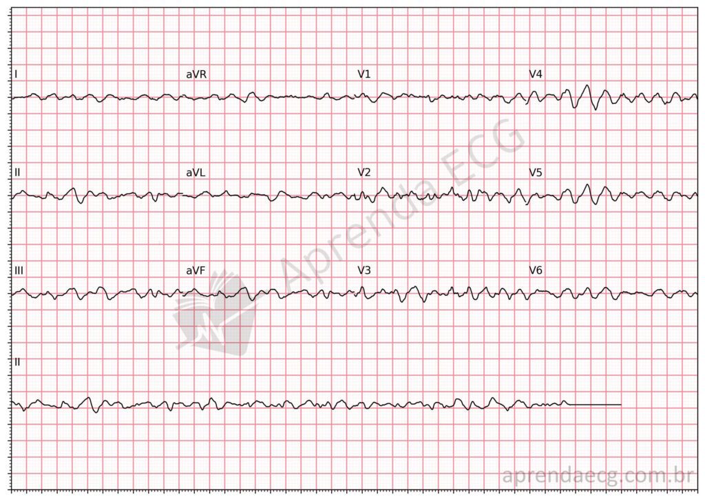Eletrocardiograma com fibrilação ventricular