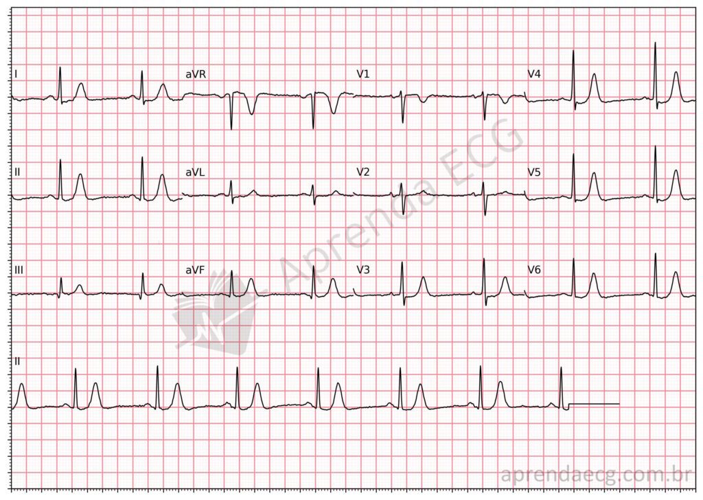Eletrocardiograma com hipercalemia