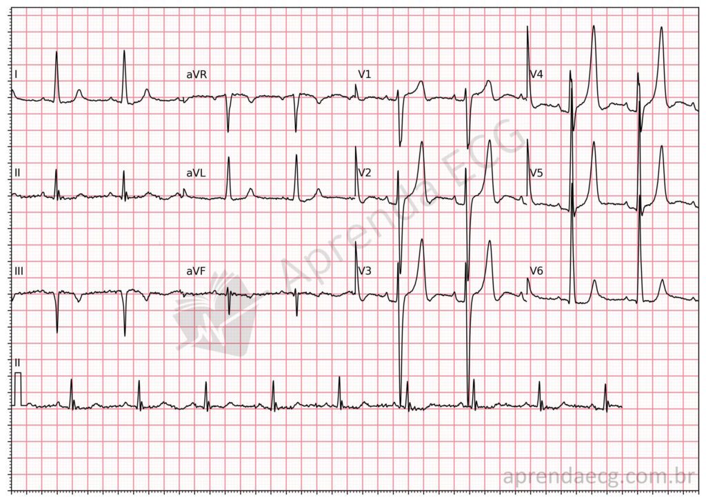 Eletrocardiograma com hipercalemia