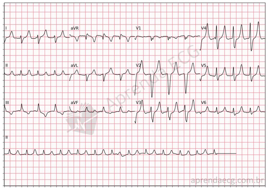 Eletrocardiograma com hipercalemia