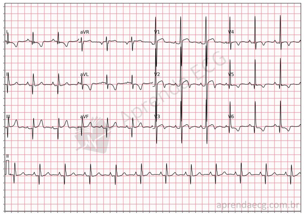 Eletrocardiograma com cardiomiopatia hipertrófica