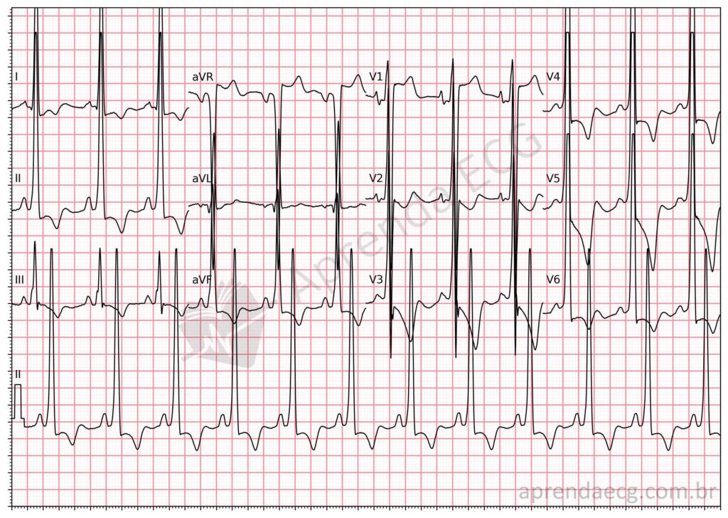 Eletrocardiograma com cardiomiopatia hipertrófica
