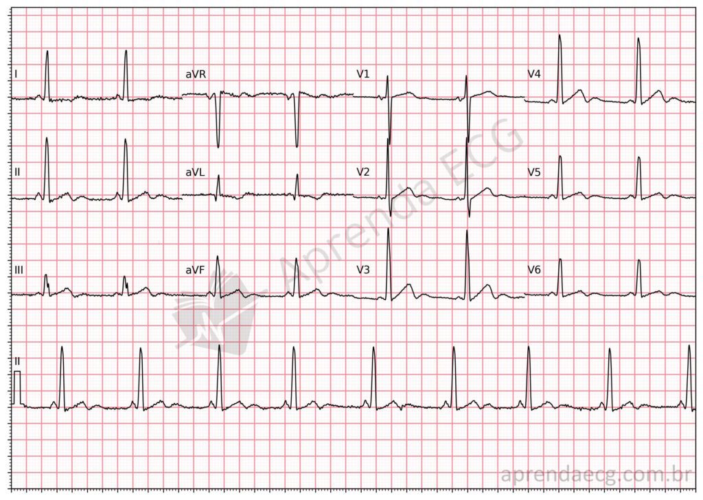 Eletrocardiograma com hipocalemia a onda U