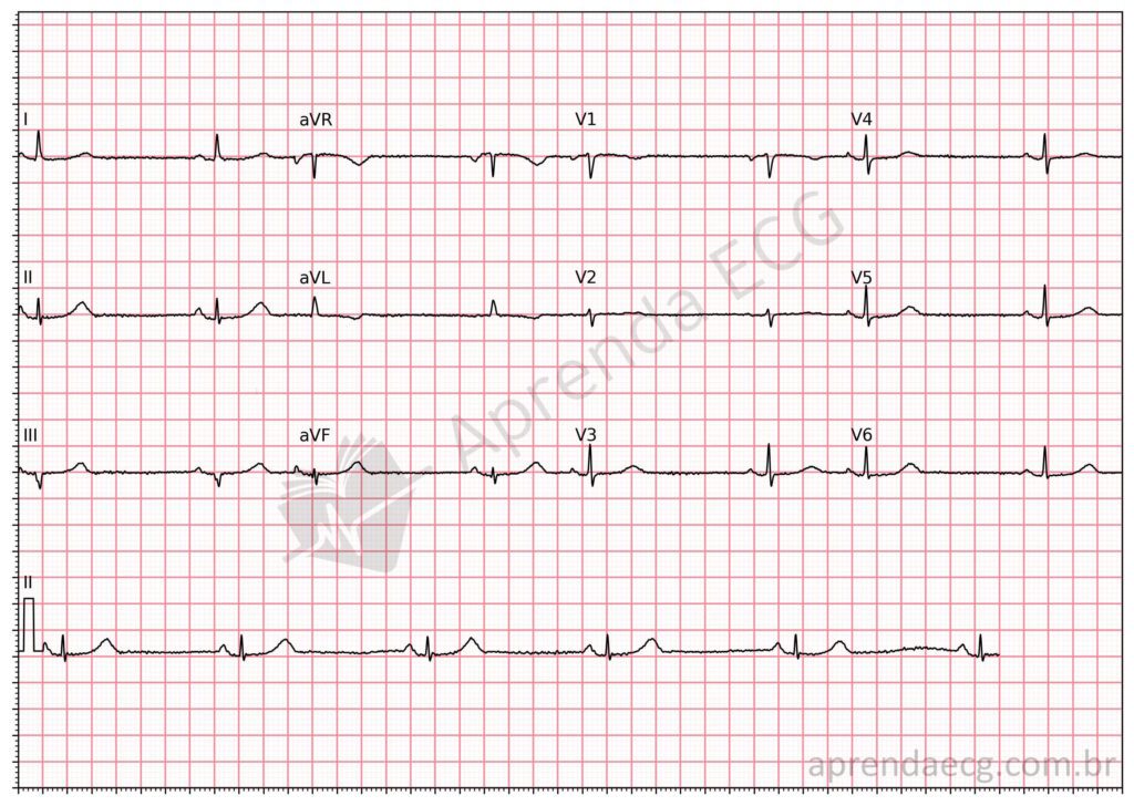 Eletrocardiograma no hipotireoidismo