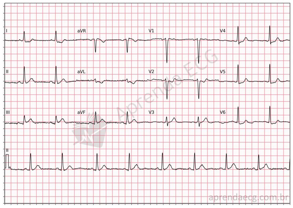 Eletrocardiograma com infradesnivelamento de aVL