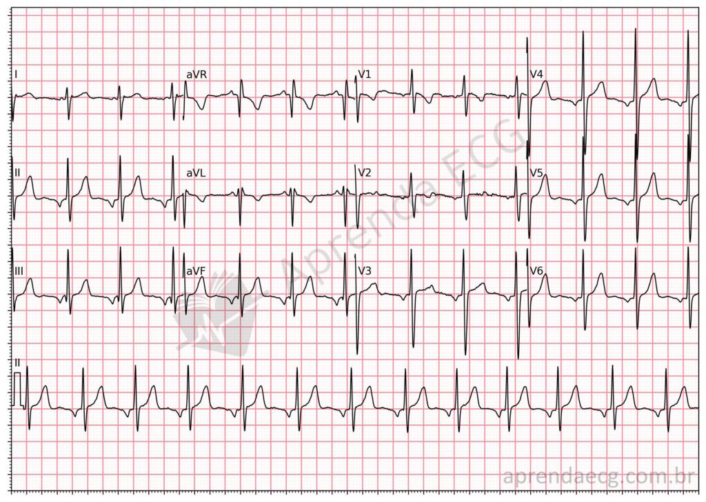 Eletrocardiograma com ritmo atrial ectópico