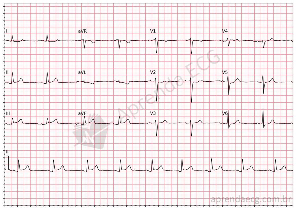 Eletrocardiograma com supradesnivelamento discreto do segmento ST