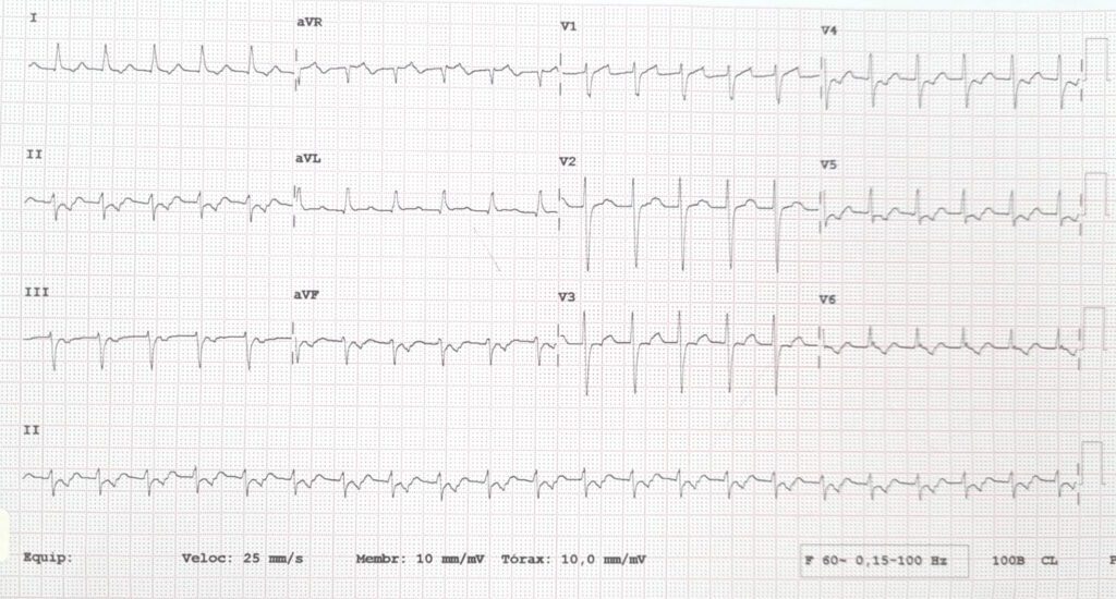 Eletrocardiograma com taquicardia por reentrada atrioventricular