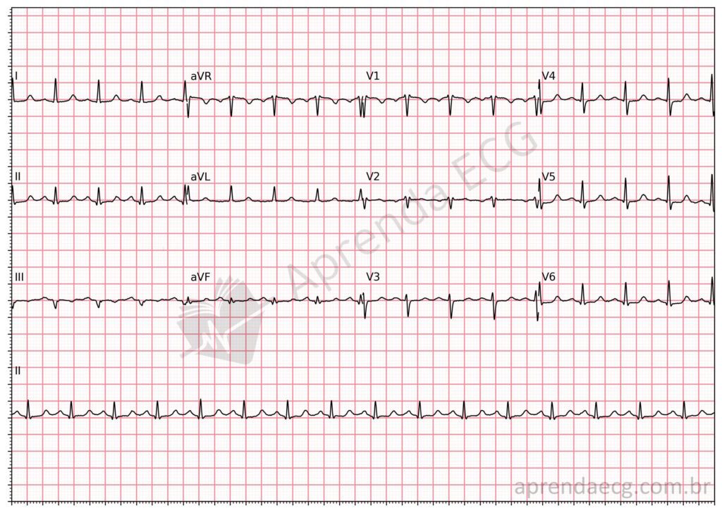 Eletrocardiograma de taquicardia por reentrada nodal após reversão com adenosina