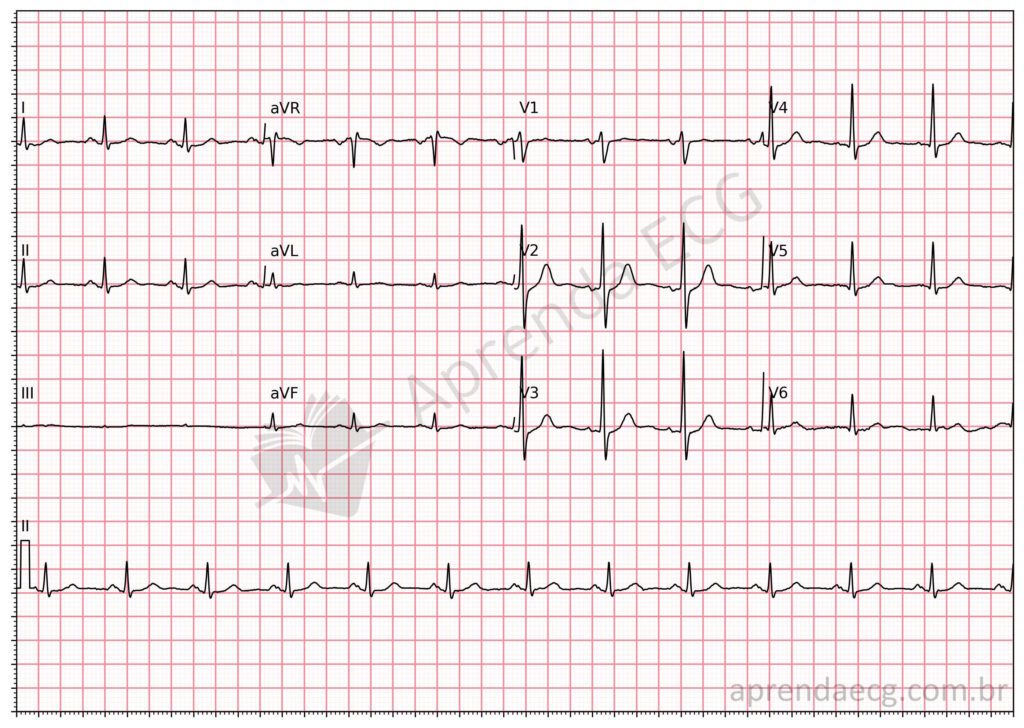 Eletrocardiograma com troca de eletrodos