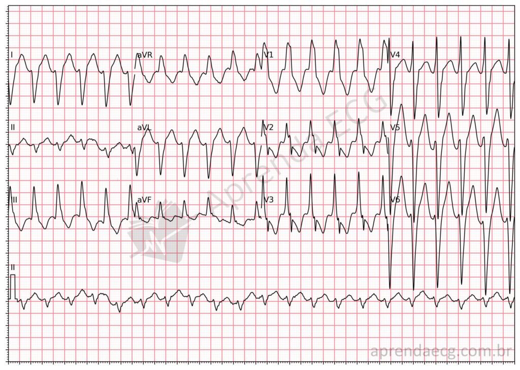 Eletrocardiograma com taquicardia ventricular
