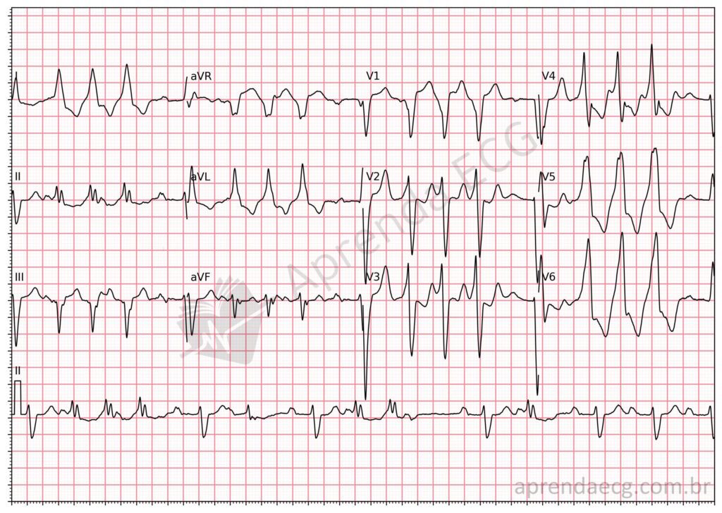 Eletrocardiograma com taquicardia ventricular não sustentada