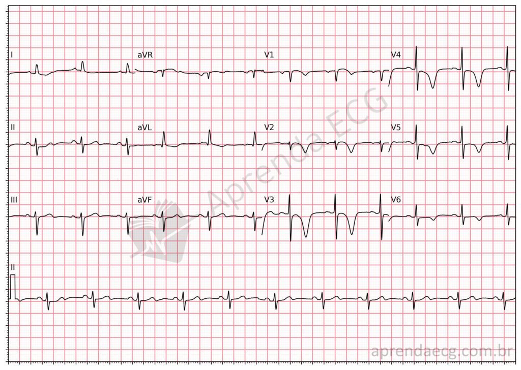 Eletrocardiograma com síndrome de wellens e onda t negativa