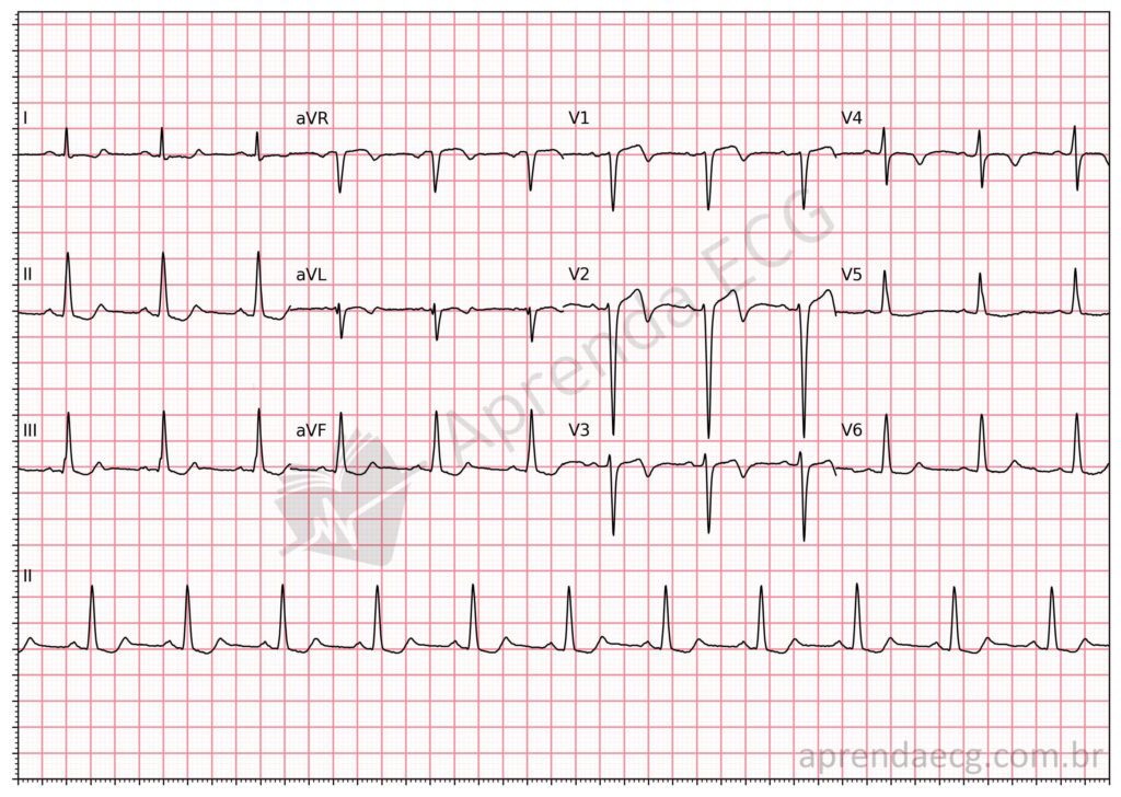 Eletrocardiograma com síndrome de wellens e onda T plus minus