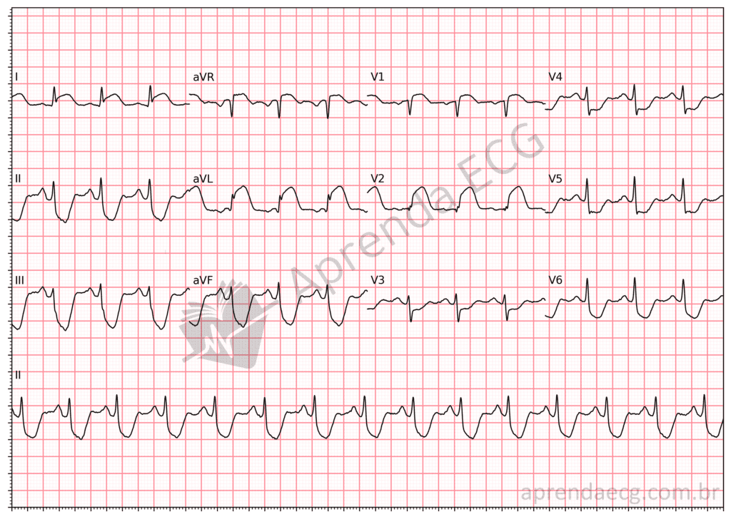 Eletrocardiograma com supradesnível de ST em D1, aVL e V2 e infradesnível inferior
