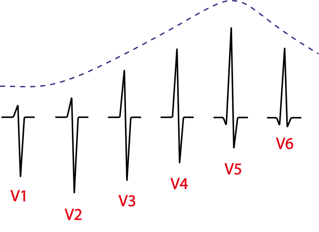Desenho representando a progressão normal da onda R no eletrocardiograma nas derivações V1 a V6