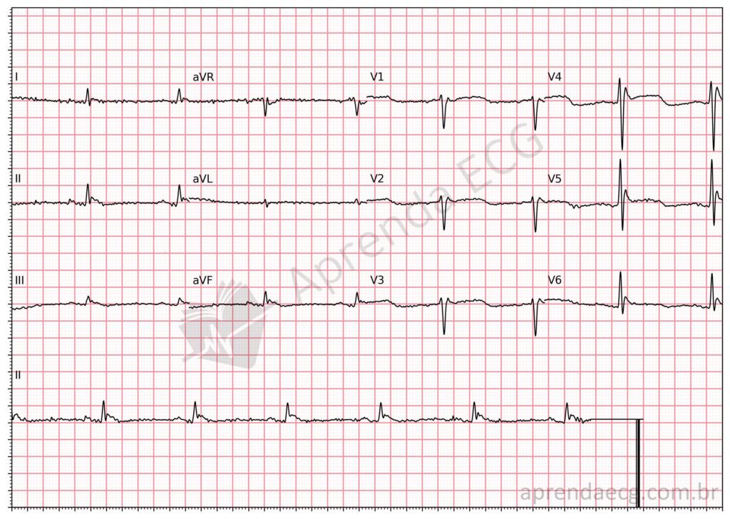 Eletrocardiograma na hipotermia