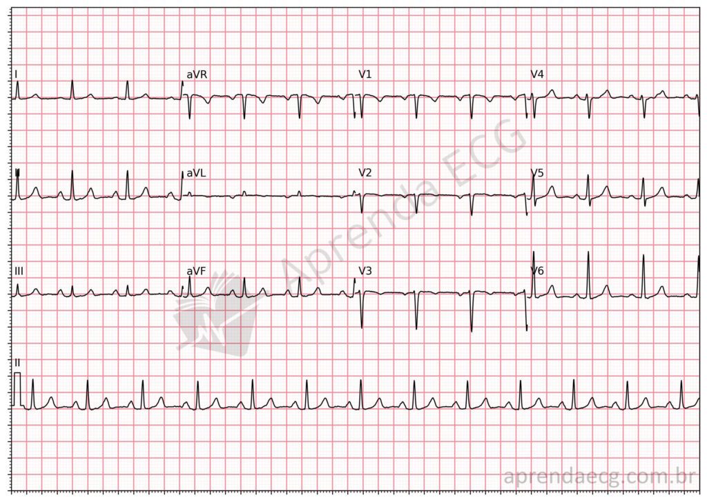 Eletrocardiograma com progressão lenta da onda R