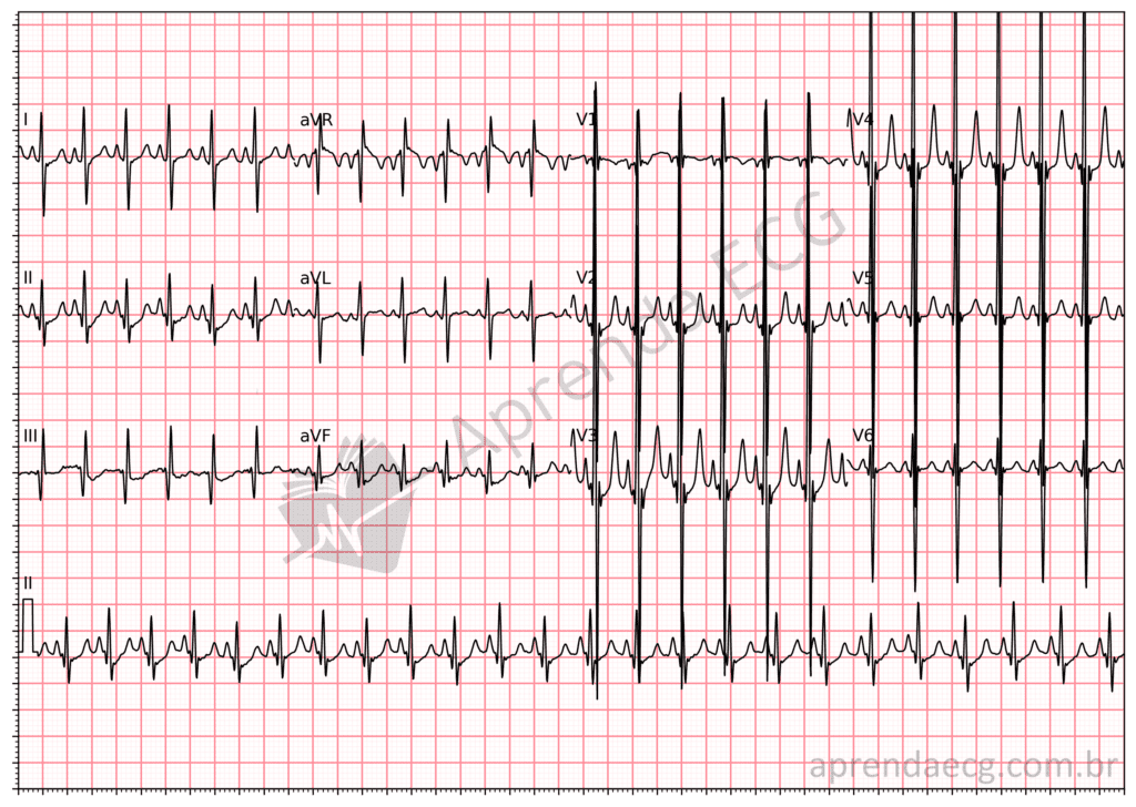 Eletrocardiograma com sobrecarga biventricular e fenômeno de Katz-Wachtel
